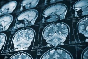Brain on ct scan